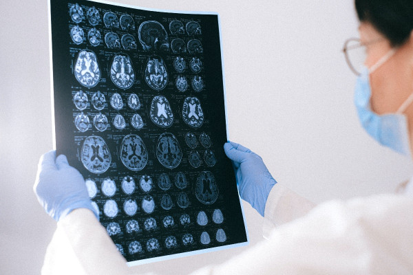 Αλτσχάιμερ: Φώς στο «μυστήριο» καταστροφής των εγκεφαλικών κυττάρων
