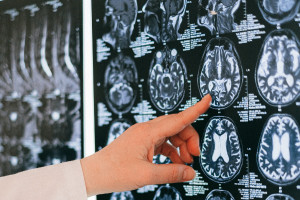 Έλον Μασκ: Επιτυχής η πρώτη εμφύτευση ασύρματου τσιπ εγκεφάλου σε άνθρωπο