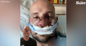 Απλαστική αναιμία: 31χρονος έχασε τη μύτη του λόγω της ασθένειας - Τι είναι