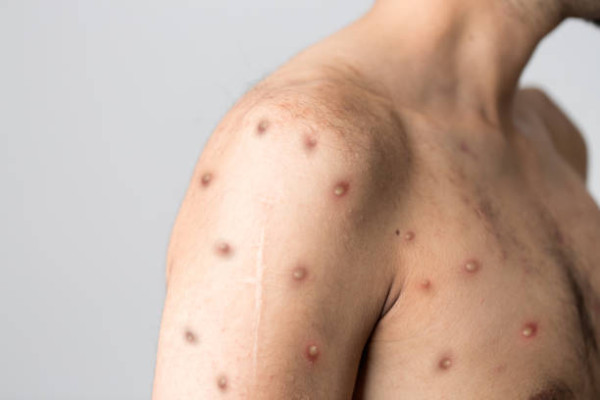 Το CDC προειδοποιεί για πιθανή επανεμφάνιση της Mpox