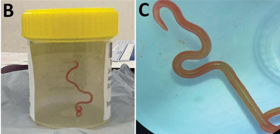 Ζωντανό σκουλήκι οκτώ εκατοστών βρέθηκε στον εγκέφαλο γυναίκας