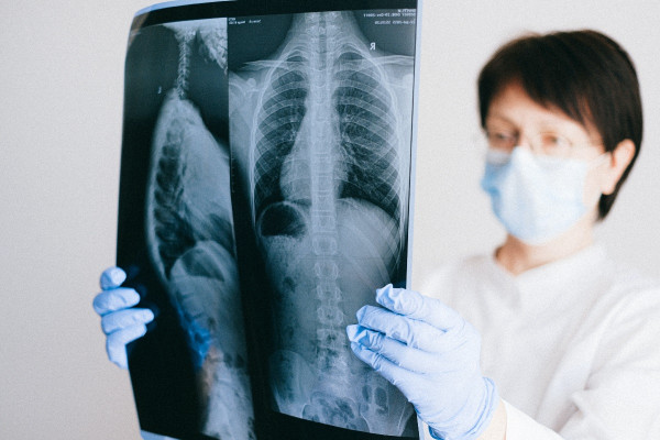 ΗΠΑ: Επιτυχείς δύο περιπτώσεις διπλής μεταμόσχευσης πνευμόνων σε ασθενείς