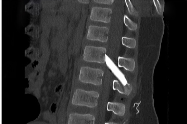 Επιτυχής χειρουργική επέμβαση στη σπονδυλική στήλη παιδιού με σοβαρά τραύματα από γυαλί