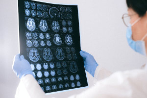 Θερμίδες και γήρανση του εγκεφάλου - Πώς συνδέονται