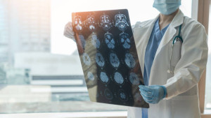 Αλτσχάιμερ: Σύγκρουση ερευνητών για τα αποτελέσματα νέων θεραπειών