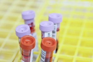 Νέες οδηγίες για τον καρκίνο του παχέος εντέρου στις ΗΠΑ - Εξέταση αίματος για όσους δεν κάνουν κολονοσκόπηση