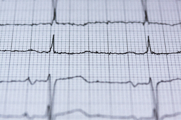 Καρδιακή προσβολή: Οι ειδικοί εξηγούν γιατί παρατηρείται αύξηση περιστατικών στους νέους