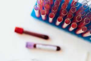 Tεστ αίματος στη «μάχη» κατά του καρκίνου - Ήδη χρησιμοποιείται στο Ηνωμένο Βασίλειο