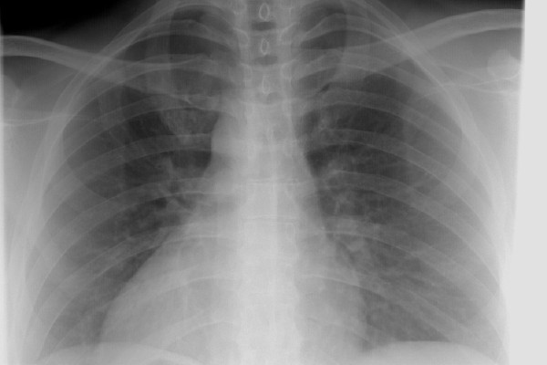 Νέα θεραπεία mRNA στοχεύει στην ανθεκτική στα φάρμακα πνευμονία