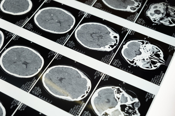 Αλτσχάιμερ: Οι υπέρηχοι κέρδισαν τη μάχη στον εγκέφαλο - «Πλησιάζουμε» λένε οι επιστήμονες