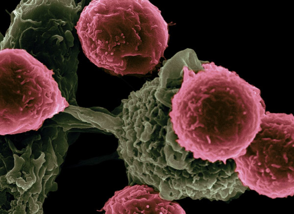 Η τεχνολογία που καταστρέφει το 99% των καρκινικών κυττάρων