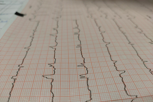 Σύνδρομο «ραγισμένης» καρδιάς – Τα κοινά σημάδια με το έμφραγμα