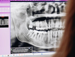 Ρευματοειδής αρθρίτιδα και δόντια: Τι πρέπει να γνωρίζετε