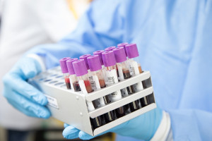 Καρκίνος κεφαλής και τραχήλου: Πρωτοποριακή ανακάλυψη ενός τεστ αίματος που υπόσχεται πρώιμη διάγνωση