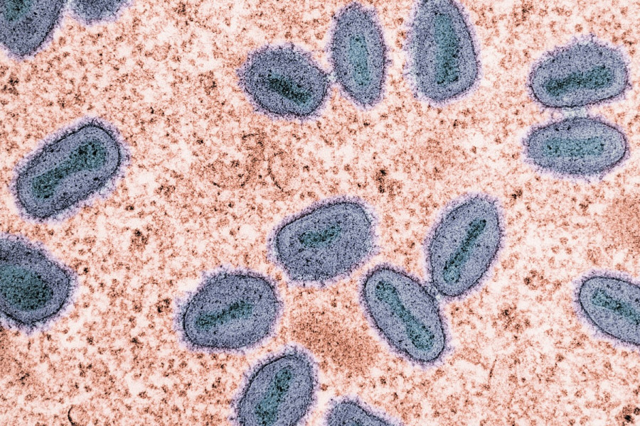 Ευλογιά των πιθήκων: Νέα παραλλαγή του ιού εντοπίστηκε στη Βρετανία