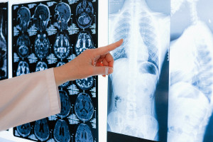 Η τεχνητή νοημοσύνη στη «μάχη» κατά του καρκίνου του πνεύμονα