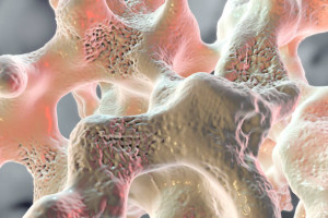 Ποιες 9 παθήσεις και θεραπείες μπορούν να αυξήσουν τον κίνδυνο οστεοπόρωσης