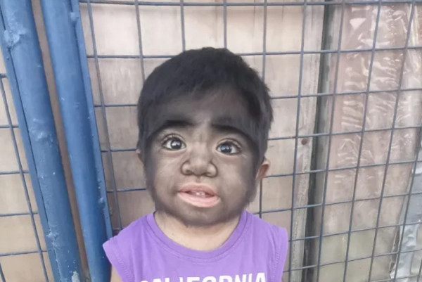 Τι είναι το «σύνδρομο λυκάνθρωπου» - Η ιστορία ενός 2χρονου από τις Φιλιππίνες που γεννήθηκε με το σπάνιο σύνδρομο