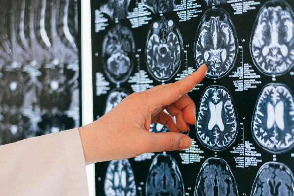 Κορωνοϊός: Πώς επηρεάζει τη λειτουργία του εγκεφάλου